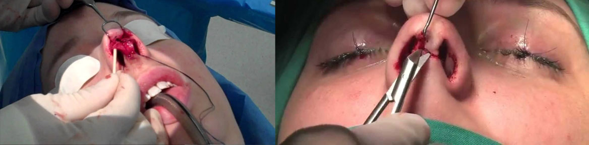 Rhinoplasty in Jaipur